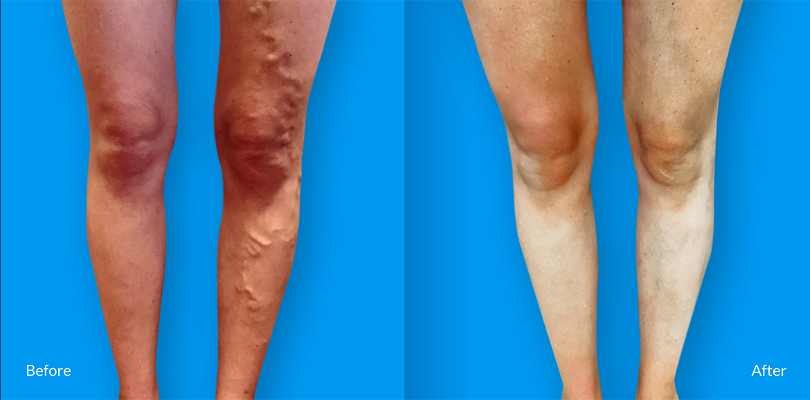 before and after operation legs